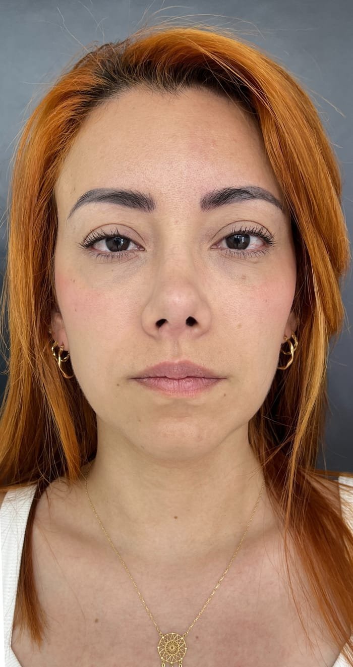 Resultado de bioestimulación con Radiesse aplicado por la Dra. Diana Dussan